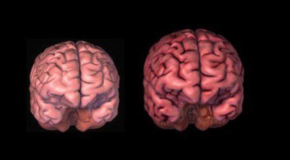 Denis Milani kokraklari